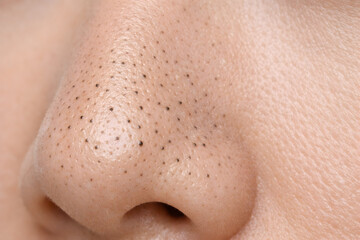 Fototapeta premium Close-up of Blackheads on Nose Skin Texture
