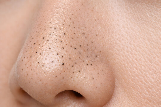 Close-up of Blackheads on Nose Skin Texture