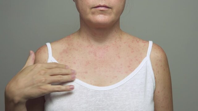 A woman with a red, spotty rash caused by measles.