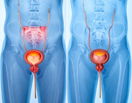Bladder Health Comparison - Healthy vs. Enlarged Prostate Anatomy.