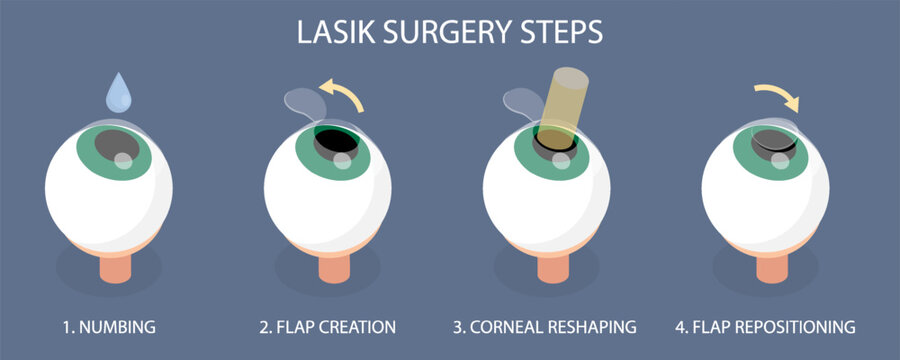 Lasik eye surgery steps procedure (numbing, flap creation, corneal reshaping, flap repositioning). 3d flat isometric vector illustration on dark background.