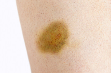 Close-up of bruise of hitting in the leg of woman on white background