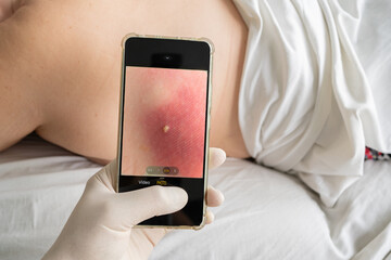A doctor takes pictures with a cell phone of a mole on the back of a patient lying face down on the examination table