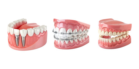 Dental implant braces and teeth models displayed clearly on transparent background