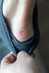 Obraz premium Foot with a painful blister and callus caused by uncomfortable shoes. Skin irritation on the heel shows friction, pressure, and foot discomfort during walking or daily activity.