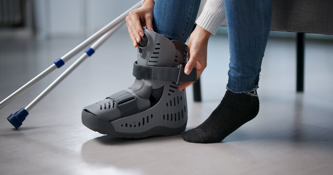 Woman Receives Treatment For Broken Leg After Joint Fracture Injury