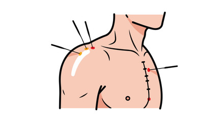 Vector illustration of male torso with acupuncture needles and surgical stitches