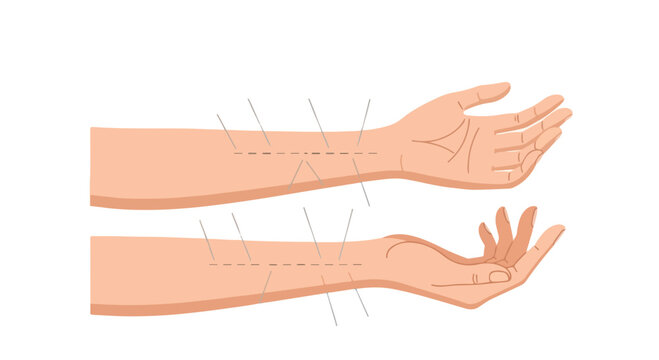 Acupuncture needles in two human forearms on a white background