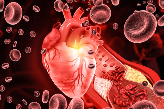 3D Medical Render of Coronary Atherosclerosis: Cholesterol Plaque Blocking Heart Artery