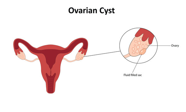 Ovarian cyst vector illustration