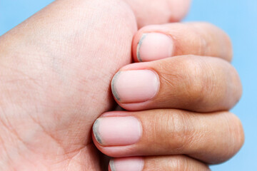 Fototapeta premium Close up of dirt that accumulates under fingernails. Hand care. Personal hygiene