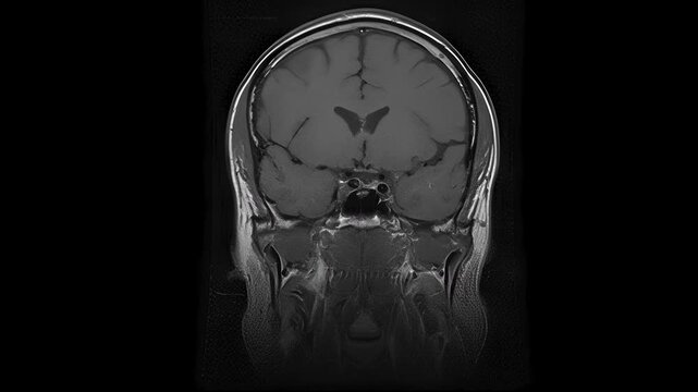 MRI Results in Frontal Projection. MRI scanning with spatial layer analysis in brain research demonstrates the technology's high effectiveness in detecting abnormalities associated with cognitive diso
