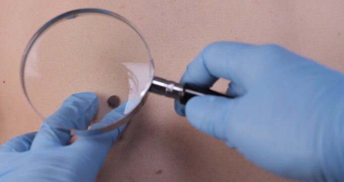 Close-up of a doctor inspecting a mole with a magnifying glass. Skin check, dermatology and medical examination concept for health and wellness content.
