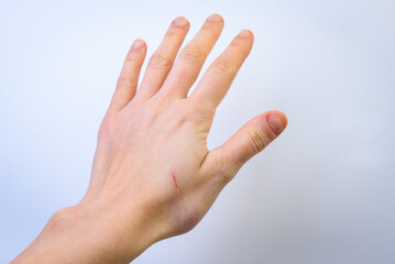 Blue bruise on the arm. Hand with a swollen bone after after a fall, enlarged in size on gray background.