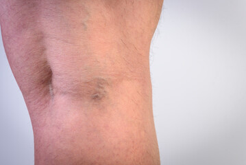Naklejka premium Initial stage of venous disease - varicose veins in the knee area on a gray background.