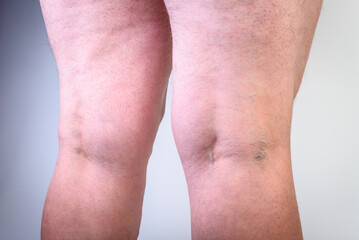 Initial stage of venous disease - varicose veins in the knee area on a gray background.