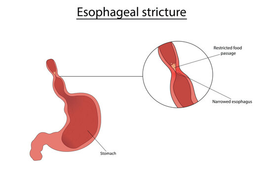 Esophageal stricture vector illustration