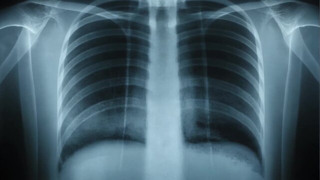 Chest Xray Image.