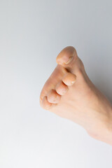 巻き爪・陥入爪の症状が出ている足の爪