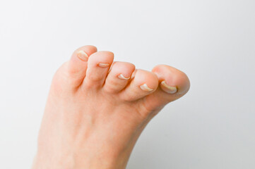 巻き爪・陥入爪の症状が出ている足の爪