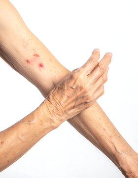 An elderly person's arm showing skin conditions, isolated on white