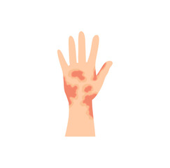 Fototapeta premium Dermatitis eczema skin conditions and disease. Vector illustration