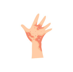 Obraz premium Dermatitis eczema skin conditions and disease. Vector illustration