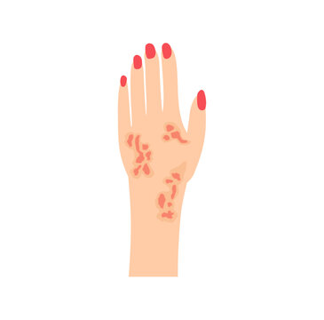 Dermatitis eczema skin conditions and disease. Vector illustration