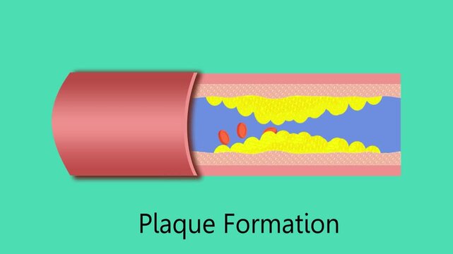 Angioplasty. Stent Implantation. Deflated balloon catheter inserted into a coronary artery narrowed by plaque. the balloon is inflated, compressing the plaque against the artery wall - 2D animation