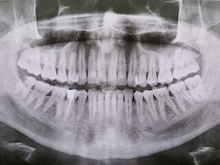 Panoramic dental x-ray image showing human teeth and jaw. Medical radiology concept, dentistry, oral health examination, diagnostic imaging, healthcare background. © Vinogradova