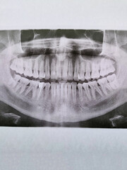 Panoramic dental x-ray image showing human teeth and jaw. Medical radiology concept, dentistry, oral health examination, diagnostic imaging, healthcare background. © Vinogradova