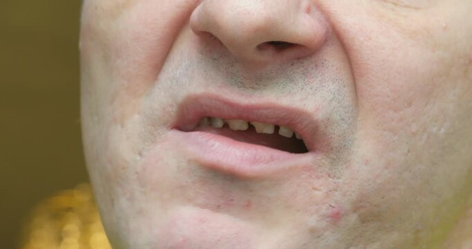 Angry man showing crooked and decayed teeth