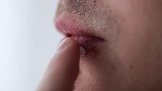Extreme close-up of a man with an unshaven face applying healing ointment with his finger to a herpes simplex virus infection on his lower lip, isolated on a white background