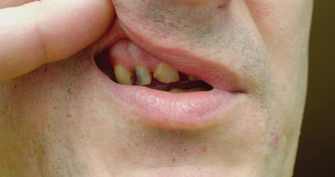 Man showing rotten and broken teeth problem