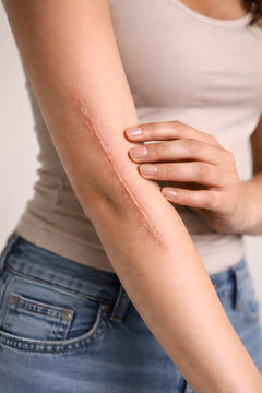 Woman Touching Healed Keloid Scar on Elbow, Realistic Skin Texture, Medical and Dermatology Concept