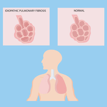 Vector illustration of idiopathic pulmonary fibrosis showing breathlessness, dry cough, fatigue, and lung scarring, with related conditions such as interstitial lung disease and pneumonitis silhouette