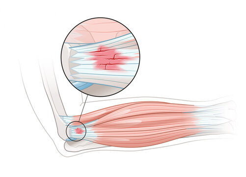 Tennis elbow injury with inflamed extensor tendon anatomy illustration