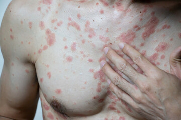 Itchy rash