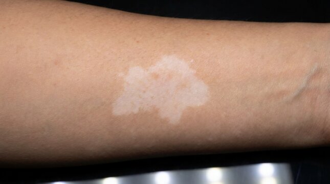 Close up view of vitiligo patch on human arm skin