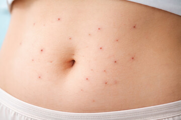 Skin abdomen rash red spot irritation allergy scar medical care Glucose and insulin affect blood sugar balance and poor diabetic care may lead to skin rash and irritation with red spot abdomen