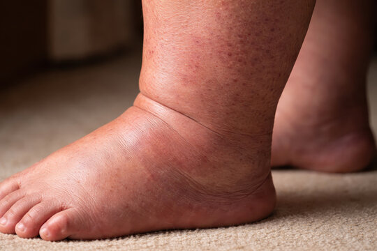 Swollen leg swollen foot edema diabetic glucose insulin blood sugar medical health healthcare swollen ankle skin rash chronic disease circulation foot care leg care ankle care fluid retention