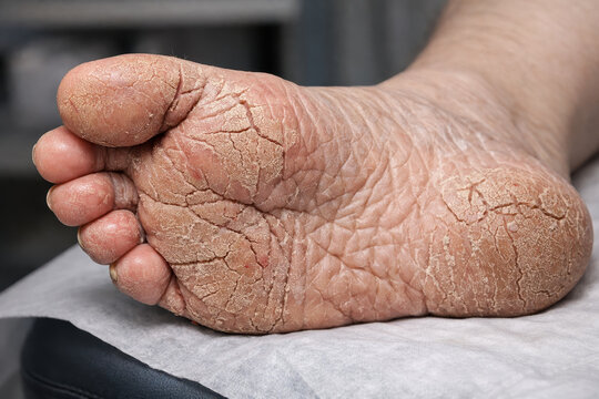 Diabetic foot dry skin cracked heel closeup medical healthcare senior dermatology texture rough skin Diabetic foot with severe dry cracked heel closeup medical table, detailed rough skin texture