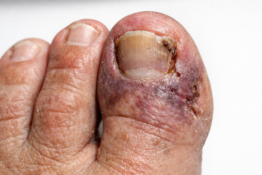 Infected toe swollen toe bruised toe damaged toenail diabetic neuropathy foot ulcer poor circulation skin infection close up medical problem painful injury infected toe with swollen toe