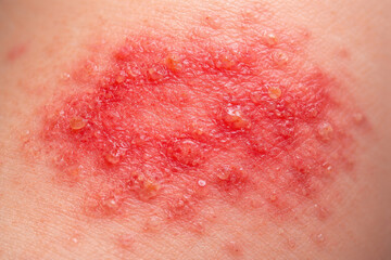 Fototapeta premium Skin rash irritation inflammation redness allergy eczema blister infection macro