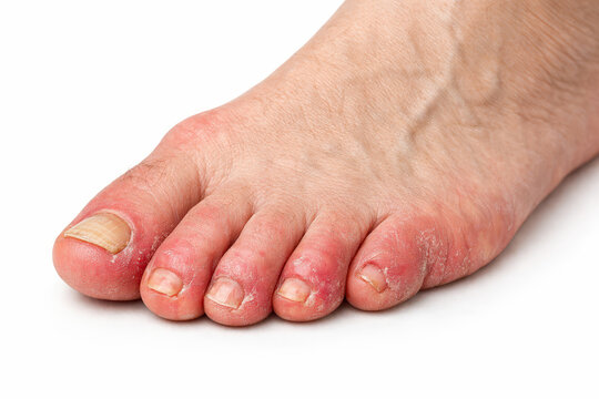 Diabetic foot neuropathy foot ulcer toe infection skin inflammation dry skin medical condition dermatology close up hygiene concern Professional close up view of diabetic foot neuropathy with toe