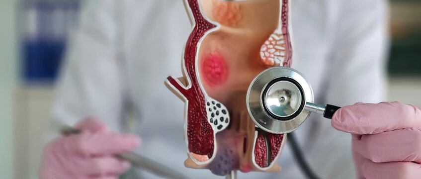 Anatomical model of rectum for hemorrhoids and doctor with stethoscope concept