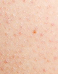 Fototapeta premium A person has a rash on their arm