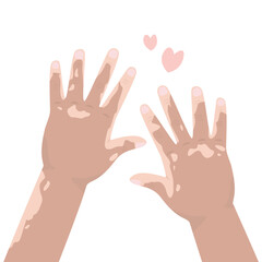 Fototapeta premium Hands with vitiligo, parts of body. Person with pigmentation on skin. Character with Vitiligo skin problems. Close Up, top view. World Vitiligo Day.