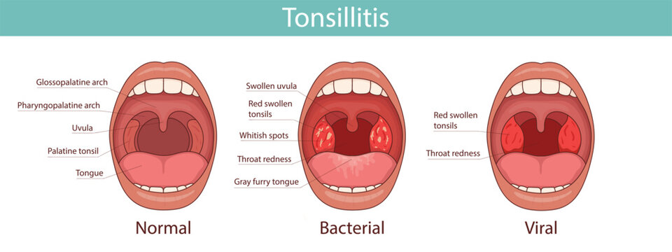 Medical anatomical illustration. Tonsillitis can be bacterial or viral in nature. Infection of the tonsils. Open mouth, anatomy.