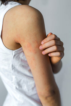 Child scratching irritated shoulder with visible redness  dry rash on upper arm showing sensitive skin flare inflammation itching discomfort  pediatric dermatology concept of atopic dermatitis allergy